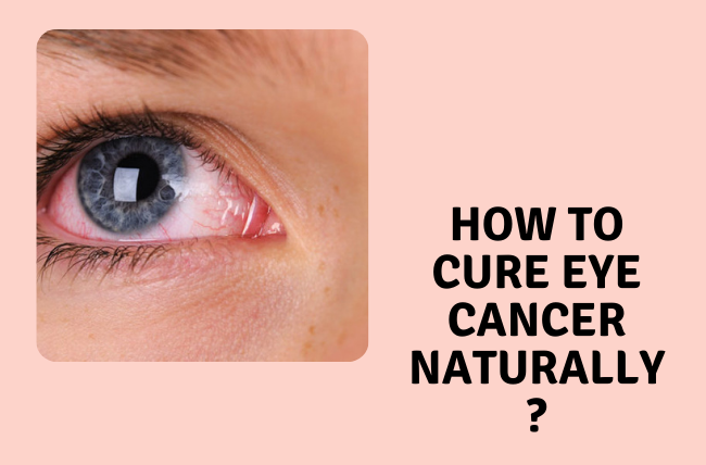 How To Cure Eye Cancer Naturally